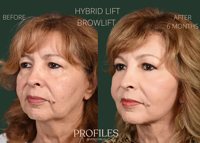 Hybrid Facelift Results Explained: 3 Months Post Surgery