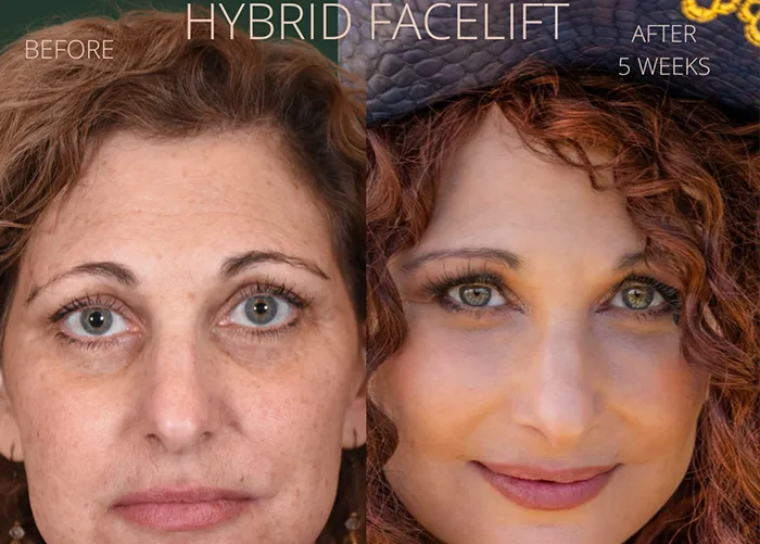 What Makes Our Signature Hybrid Facelift Unique?