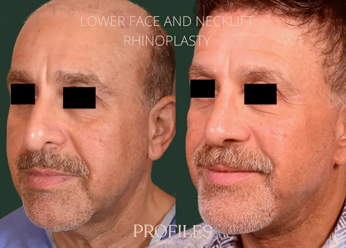 Redefining Masculine Rejuvenation: Male Rhinoplasty and Neck Lift