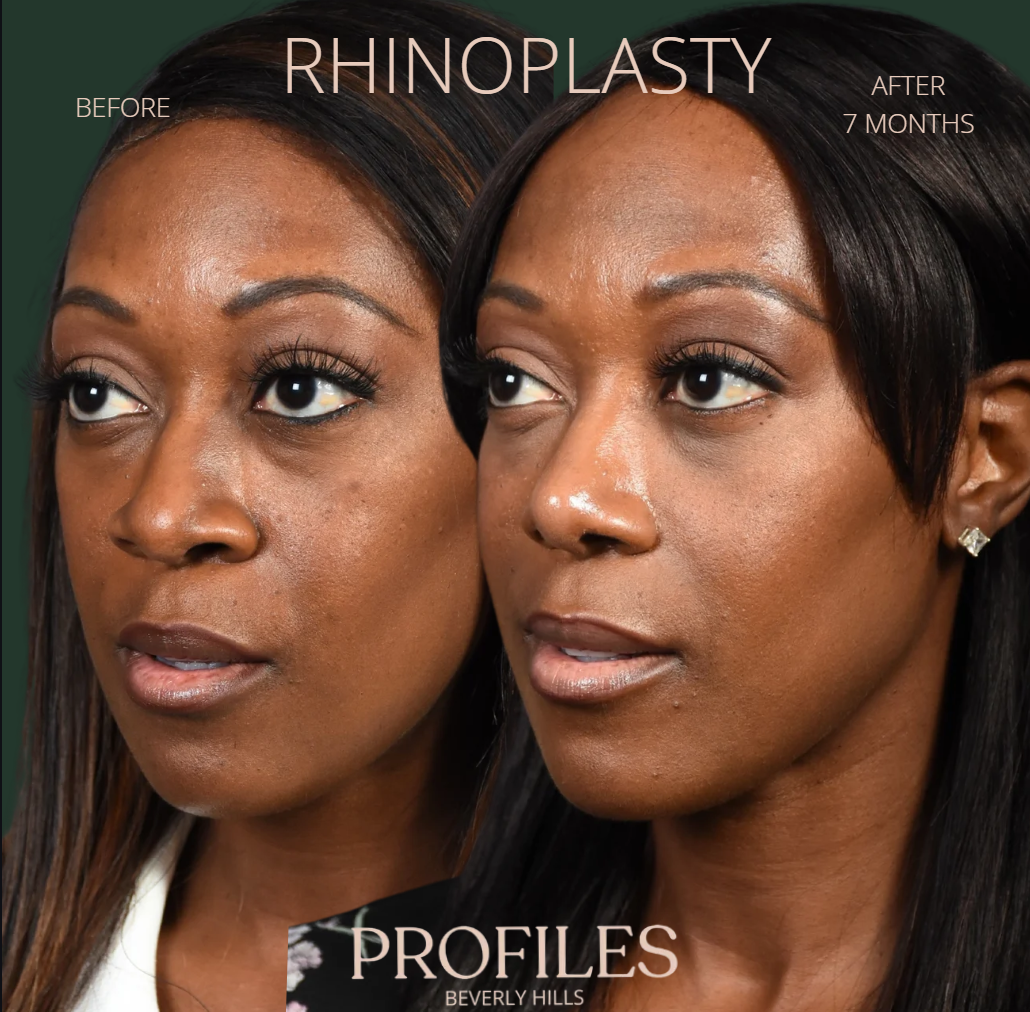 Rhinoplasty before and seven months after — oblique view 1